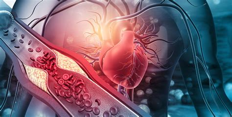 Sex And Gender Differences In Myocardial Infarction Cpd Centre