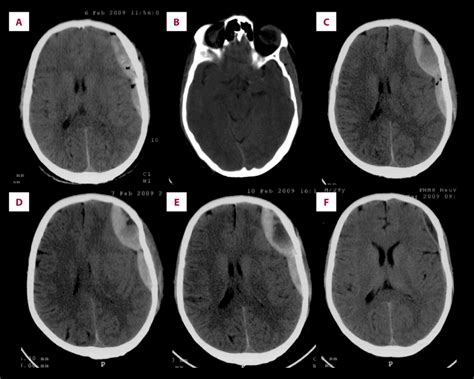 Head CT scan reveals an epidural hematoma on left fronto temporal ...