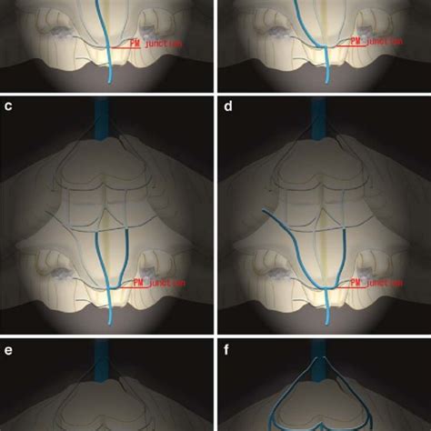 Types and frequencies of bridging veins. a Bridging vein to the ...