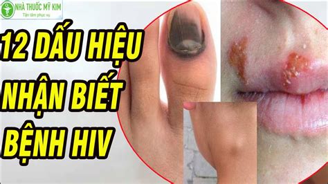 Dấu hiệu nhận biết HIV Cách xử lý khi bị HIV Triệu chứng HIV HIV