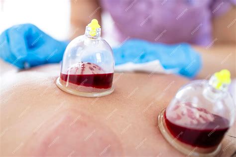 Premium Photo Hijama Master Performing Wet Cupping Treatment On Woman