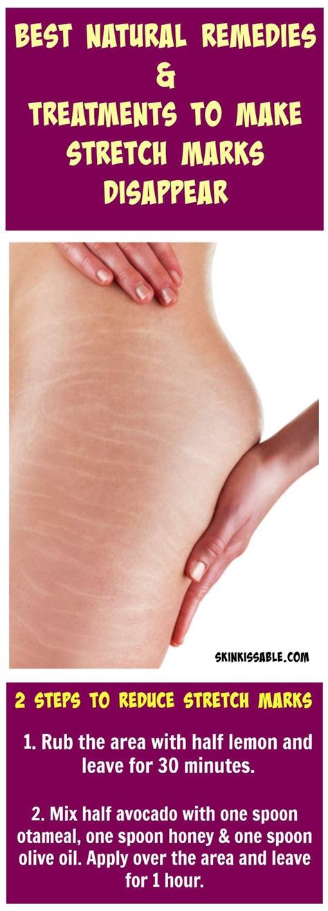 How To Treat Stretch Marks Fast Natural Diy Remedies And Treatments In