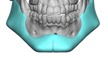 Custom Jawline Implant Design After Sliding Genioplasty Front View Dr