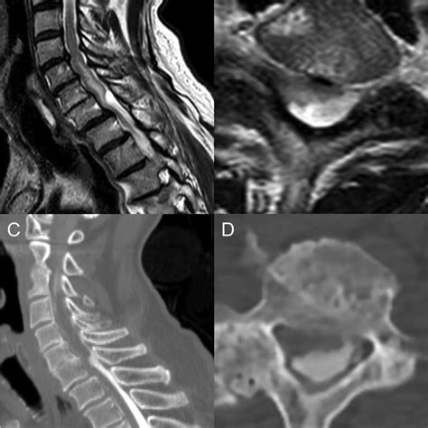 Preoperative Images T Weighted Sagittal A And Axial B Mri Show A