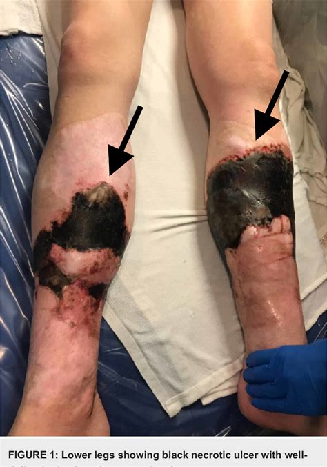 Figure 1 From Dermatitis Artefacta A Form Of Factitial Disorder