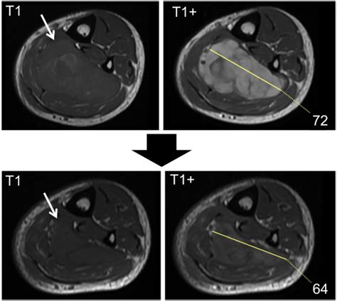 Soft Tissue Sarcomas The Role Of Quantitative Mri In Treatment