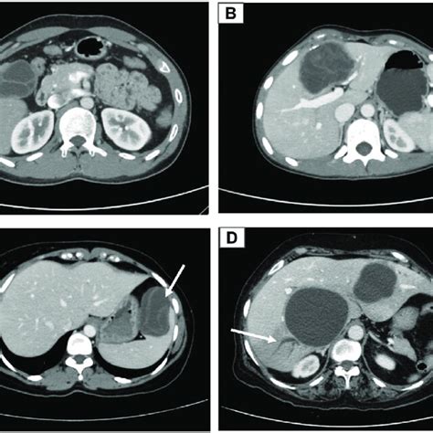 Imaging Evaluation Of Hydatid Cysts A Who Ce2 Hydatid Cyst In Segments