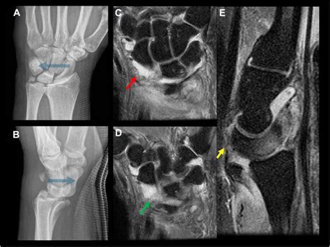 Wrist Ligaments Injuries and Instability - Radiologic Clinics