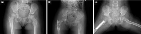 A Preoperative Anteroposterior View B Early Postoperative