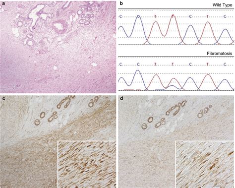 Ctnnb1 Exon 3 Mutation In Breast Fibromatosis A Breast Fibromatosis Download Scientific