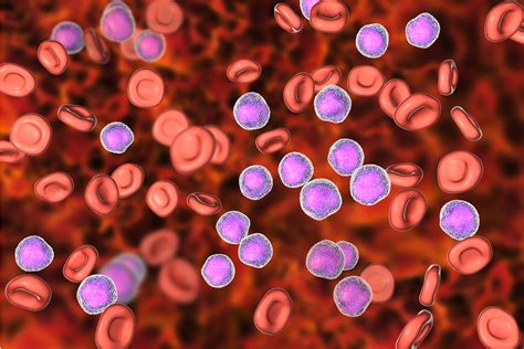 Neuer Zell Mechanismus Beim Multiplen Myelom Entdeckt MT Portal