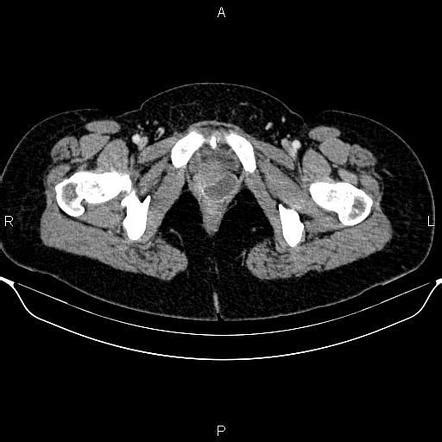 Gartner Duct Cyst Histology