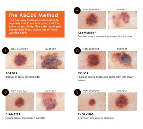 Skin Cancer Photos Early Stages