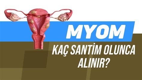 Miyom Nedir Miyomlar Neden Olur Myom Tedavi Seçenekleri Nelerdir