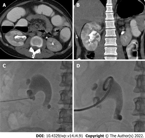 Percutaneous Nephrostomy In A 30 Yr Old Male Presented With Acute