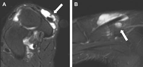 Mr Imaging Of The Midfoot Including Chopart And Lisfranc Joint