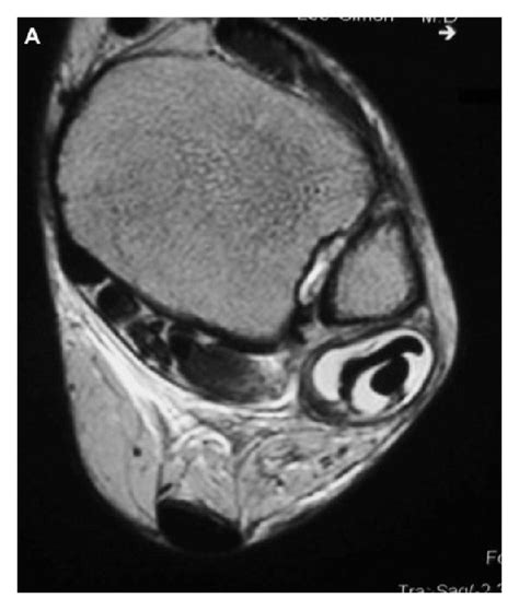 (a) T2-weight axial MRI image demonstrating peroneal tendon tendonitis ...