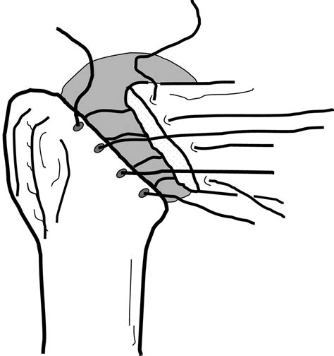 Biomechanical Evaluation Of Subscapularis Repair Used During Shoulder