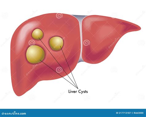 Quistes hepáticos ilustración del vector Ilustración de diagrama