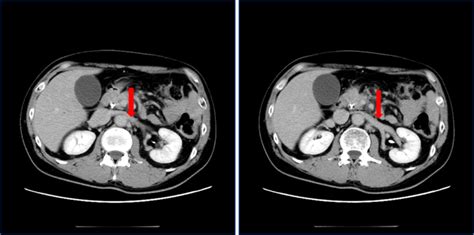 A Circumaortic Left Renal Vein Bmj Case Reports