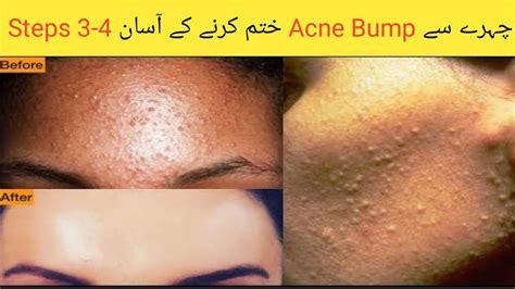 How To Remove Acne Bumps On Face Acne Bumps Khatam Karne Ka Tarika