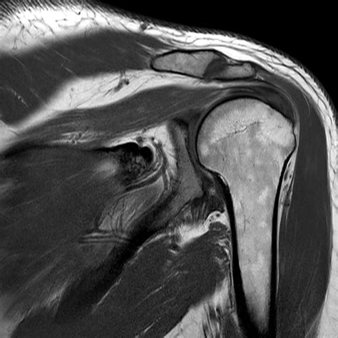 Parsonage Turner Syndrome Image Radiopaedia Org