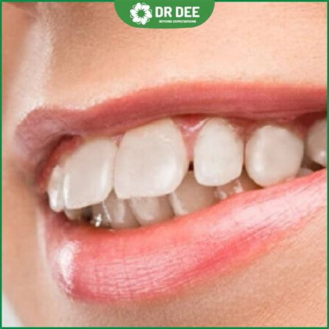 Vị Trí đặt Lưỡi Trong Miệng Bình Thường Khi Ngủ để Không Bị Hô Nha Khoa Quốc Tế Dr Dee