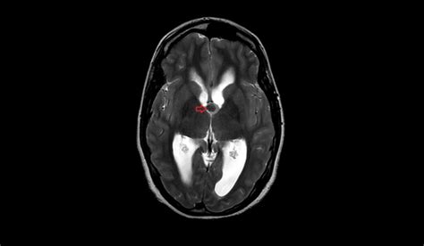 Colloid Cyst Mri Radiology Article On Colloid Cyst Of The Foramen Of Monro