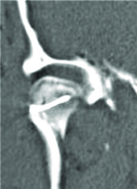 Postoperative Tomographic Image Showing An Exact Positioning Of The