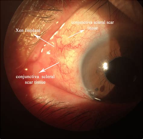 Image Of XEN Gel And The Drainage Channel With Sutures After L Year