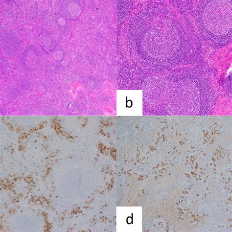 Cervical Lymph Node Histopathology Multicentric Mixed Type Castleman Download Scientific