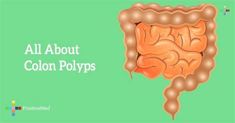 Different Types Of Colon Polyps