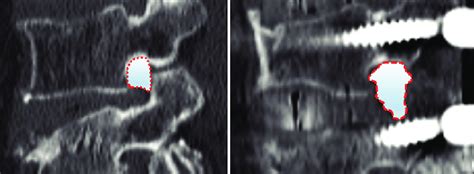 Preoperative A And Postoperative B Foraminal Area Measurements