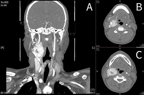 Carotid Body Tumors Chemodectoma Clinical Features And Treatment