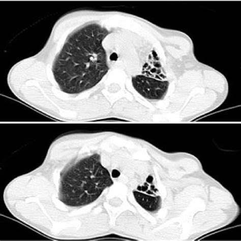 Congenital Cystic Adenomatoid Malformation Cpam A Specimen Of Right Download Scientific