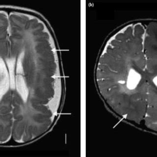 (PDF) Hemimegalencephaly and Dysplastic Megalencephaly