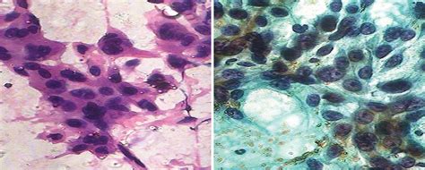 Evolution Of Pap Stain Biomedical Research And Therapy