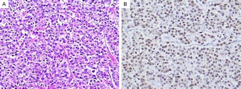 [pdf] Unclassified Mixed Germ Cell Sex Cord Stromal Tumor With Multiple