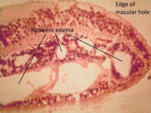 Cystoid Macular Edema Histology