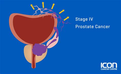 Prostate Cancer Types Signs Symptoms And Stages