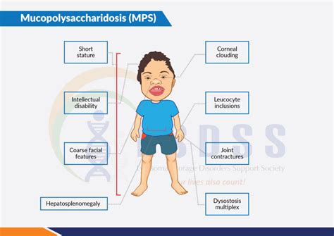 Mucopolysaccharidosis Lsdss India