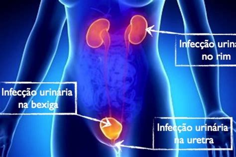 Dor E Ard Ncia Ao Urinar Pode Indicar Infec O Urin Ria Tua Sa De