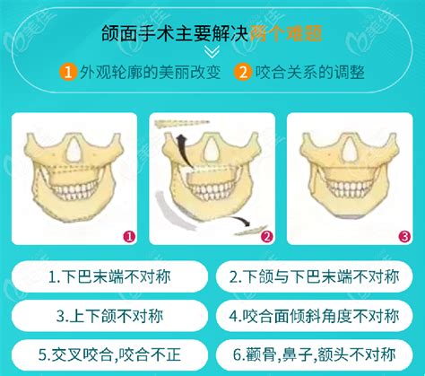 正颌手术一定要正畸吗术前正畸到什么程度可以做正颌呢 正颌手术 美佳网整形问答