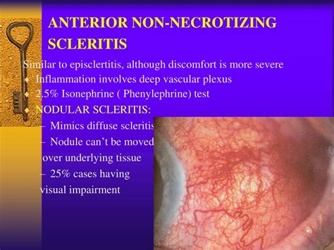 Necrotizing Scleritis With Inflammation