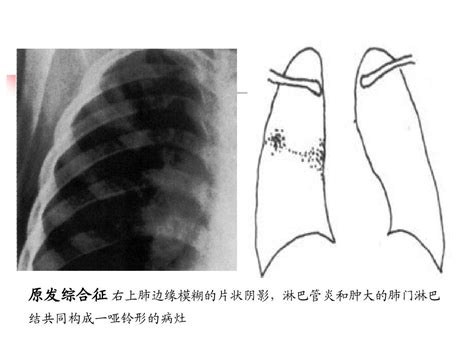 第二篇 第五章 肺结核 Word文档在线阅读与下载 无忧文档