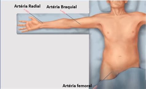 Angiografia E Angioplastia Indica Es T Cnica E Resultado