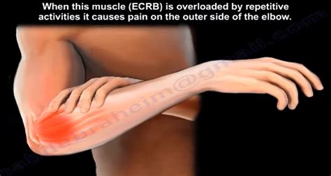 Common Medical Terminologies Related To Tennis Elbow And Their Meanings By Nabil Ebraheim