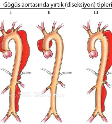 Aort Diseksiyonu Prof Dr Levent O Uzkurt