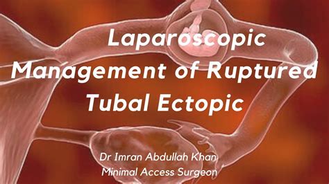 Laparoscopic Management Of Ruptured Ectopic Pregnancy Dr Imran