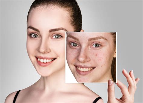 Acne And Acne Scar Treatments With Prp And Microneedling Rf